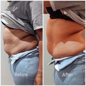 weight Loss