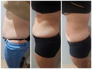 weight Loss